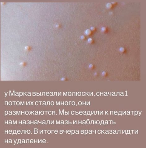 Сыну Аниты Кобелевой и Фёдора Стрелкова сделали операцию