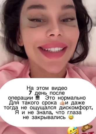 "Глаза закрываются" - Катя Колисниченко опровергла слухи о неудачной пластике