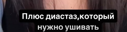 Ирина Пинчук решилась на абдоминопластику