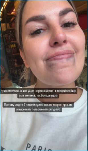 Майя Донцова поделилась страданиями из-за некачественно сделанных губ