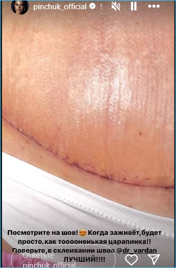 Ирина Пинчук довольна результатами дорогой операции Ирина Пинчук довольна результатами дорогой операции