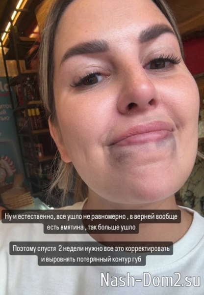 Майя Донцова рассказала о мучениях, связанных с увеличением губ Майя Донцова рассказала о мучениях, связанных с увеличением губ