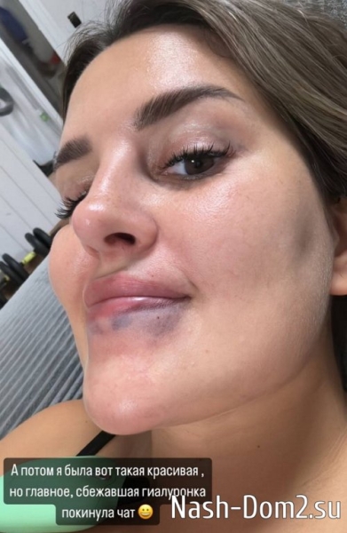 Майя Донцова рассказала о мучениях, связанных с увеличением губ Майя Донцова рассказала о мучениях, связанных с увеличением губ