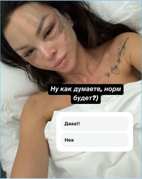 Антону Гусеву стоит обратиться к Насте Лисовой за опытом круговой пластической операции