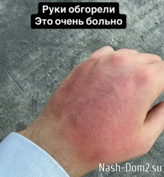 Яббаров возвращается на Дом-2 с травмой руки и хорошими новостями