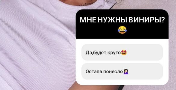 Анна Самонина после ринопластики решила поставить виниры