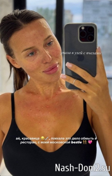 Татьяна Строкова шокировала фанатов своим «пятнистым» лицом