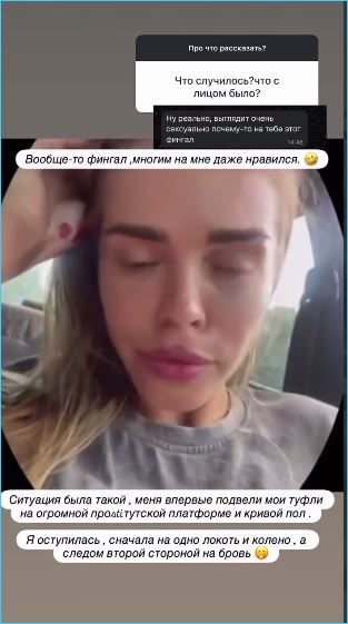 Анастасия Балинская рассказала, как она неудачно упала