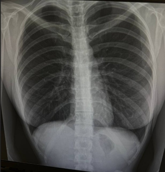 Яна Захарова сделала блефаропластику Яна Захарова сделала блефаропластику