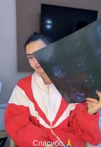 Кристина Бухынбалтэ сообщила о микроинсульте на нервной почве Кристина Бухынбалтэ сообщила о микроинсульте на нервной почве