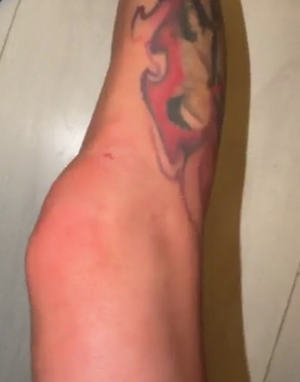 Клава Ермакович повредила ногу во время танцев Клава Ермакович повредила ногу во время танцев