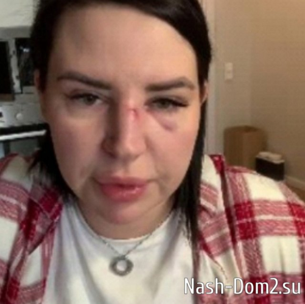 Александра Черно радует хейтеров разбитым носом Александра Черно радует хейтеров разбитым носом