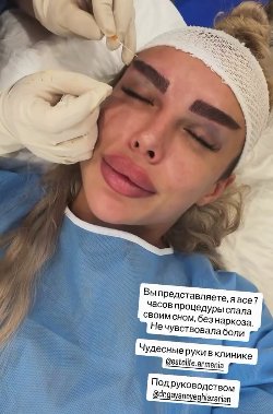 25-летняя Виктория Дилье сделала подтяжку лица 25-летняя Виктория Дилье сделала подтяжку лица