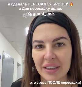 Майя Донцова сделала пересадку бровей Майя Донцова сделала пересадку бровей