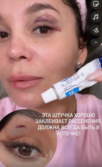 Юлия Колисниченко объяснила, почему у неё подбит глаз Юлия Колисниченко объяснила, почему у неё подбит глаз
